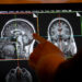 cleveland clinic ha lanzado un estudio innovador para el diagnostico y la prevencion de las enfermedades neurologicas